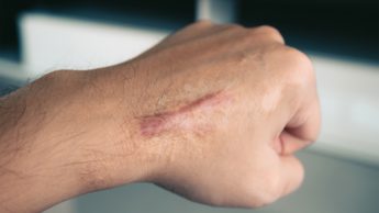 How to get rid of scars after an injury