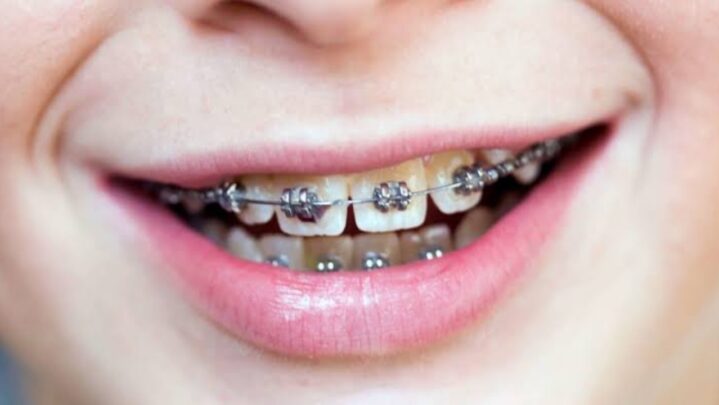 5 effective ways to get rid of braces pain