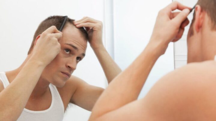 5 reasons why baldness is caused