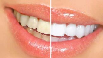 Teeth Whitening- Pros & Cons