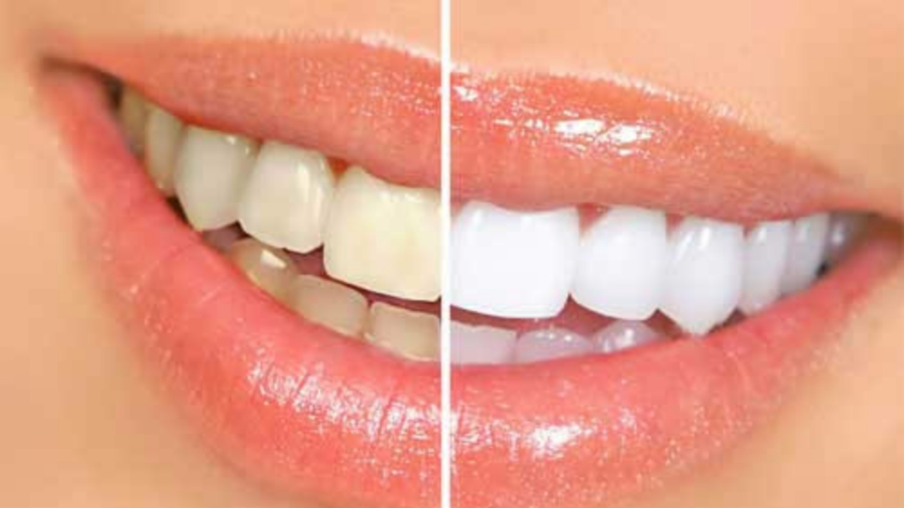 Teeth Whitening Pros & Cons SuccessYeti