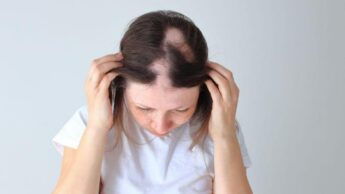 Things to know about Alopecia Areata