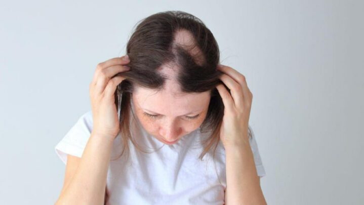 Things to know about Alopecia Areata