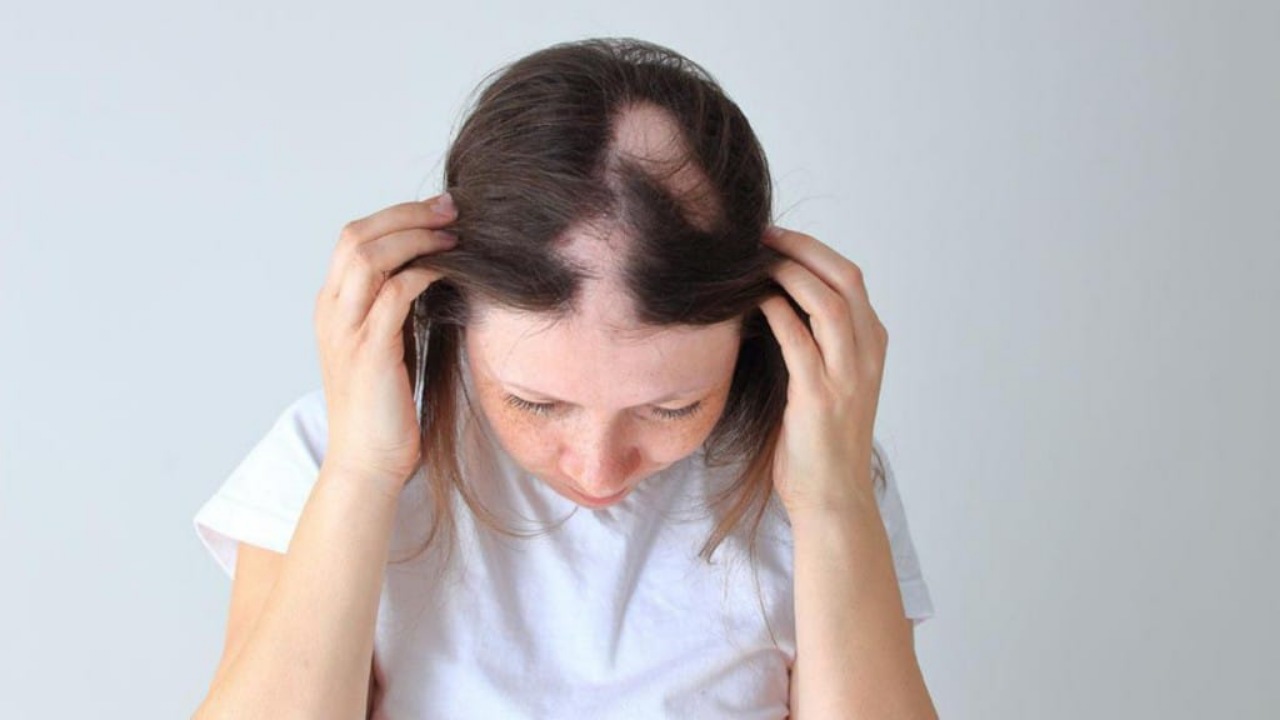 Things to know about Alopecia Areata SuccessYeti