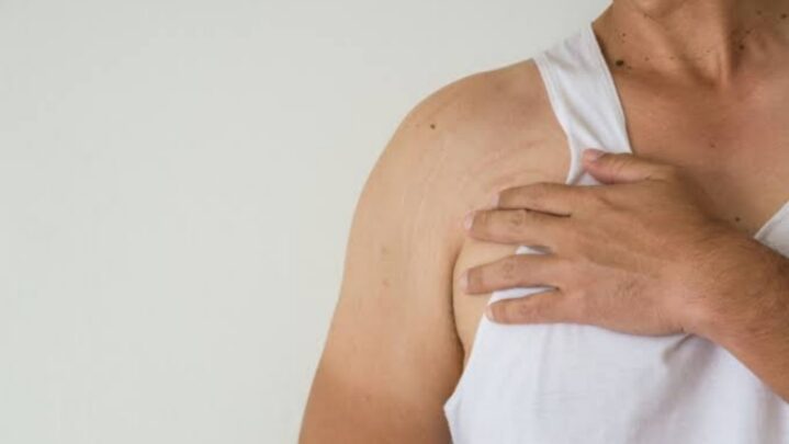 What Causes Stretch Marks On Arms & How To Deal With It