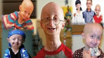 What Is Progeria? How Common Is It?