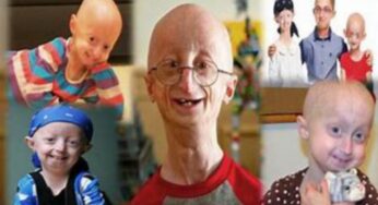 What Is Progeria? How Common Is It?