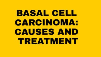 Basal Cell Carcinoma: Causes & Treatment