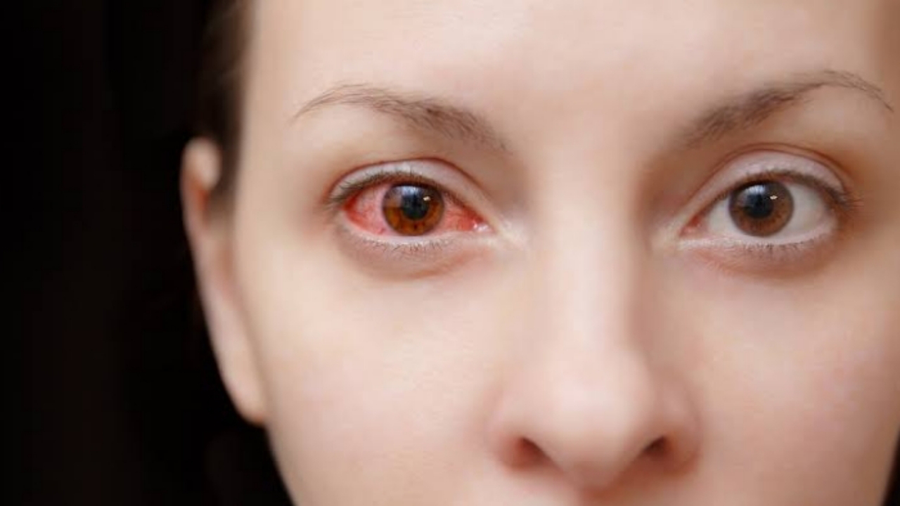 How Does Pink Eye Spread? SuccessYeti