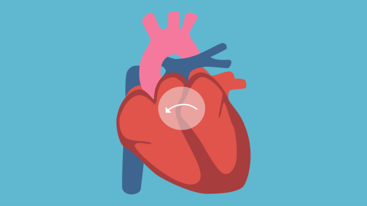 Congenital Heart Disease: Causes, Risk Factors And Symptoms