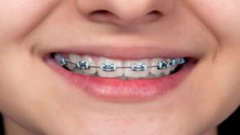 7 Signs For Parents To Know If Their Kid Needs Braces