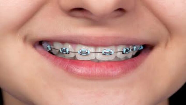 7 Signs For Parents To Know If Their Kid Needs Braces
