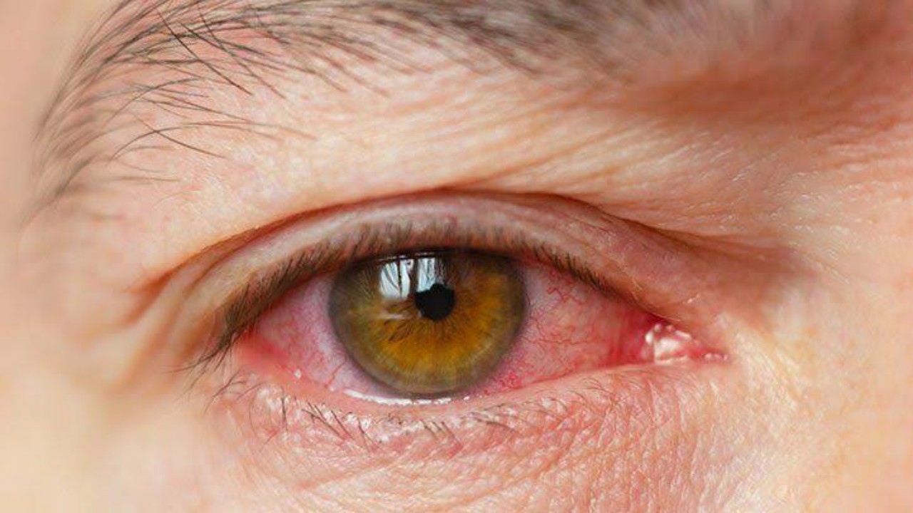 Cataracts: Prevention, Diagnosis & Treatment
