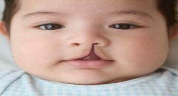 What Is Cleft Lip And Palet: Causes And Prevention