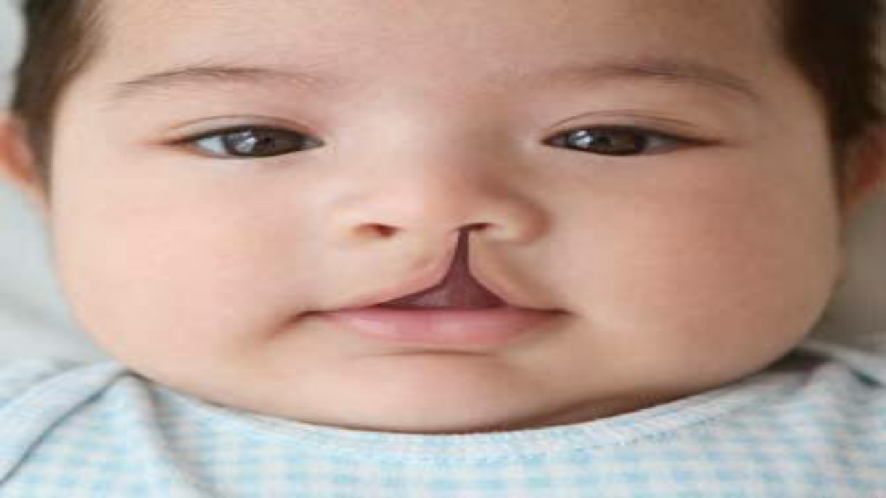 What Is Cleft Lip & Palet: Causes & Prevention