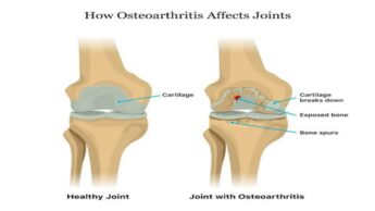 What Is Osteoarthritis: Symptoms