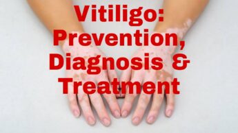 Vitiligo: Prevention, Diagnosis And Treatment