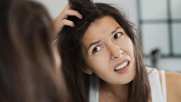 Diet To Control Your Dandruff