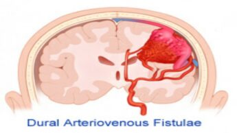 What Is Dural Arteriovenous Fistulas: Symptoms And Causes