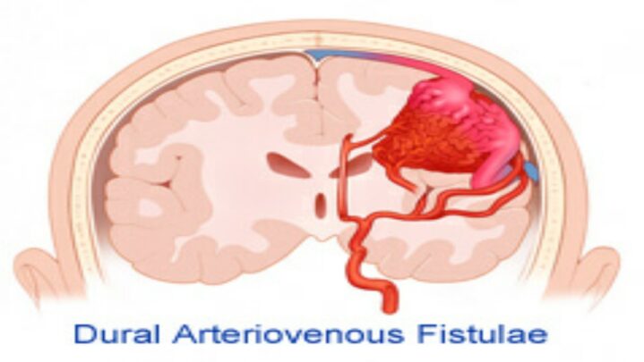 What Is Dural Arteriovenous Fistulas: Symptoms And Causes