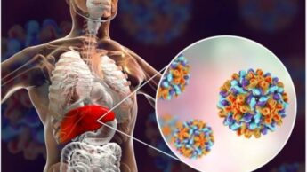 Hepatitis A: Its Treatment