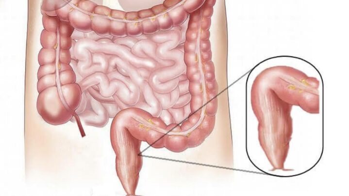 Risk Factors Of Rectal Cancer