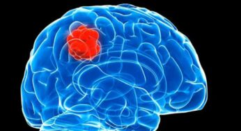 Glioma: Causes, Diagnosis, And Treatment