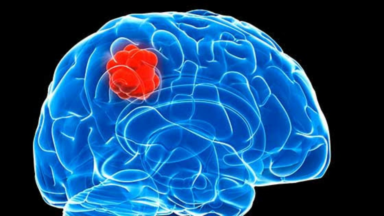 Diagnosis And Treatment For Brain Aneurysm