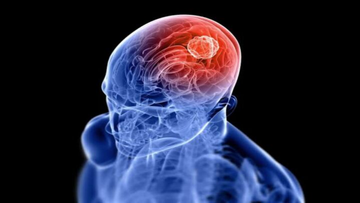 Brain Aneurysm: Symptoms And Causes