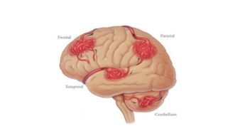 Dural Arteriovenous Fistulas: Diagnosis And Treatment