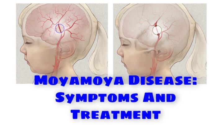 Moyamoya Disease: Symptoms And Treatment