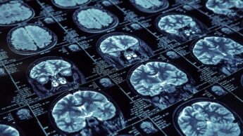 Need For ADHD Brain Scan In Diagnosing And Treating The Patient