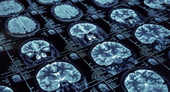Need For ADHD Brain Scan In Diagnosing And Treating The Patient