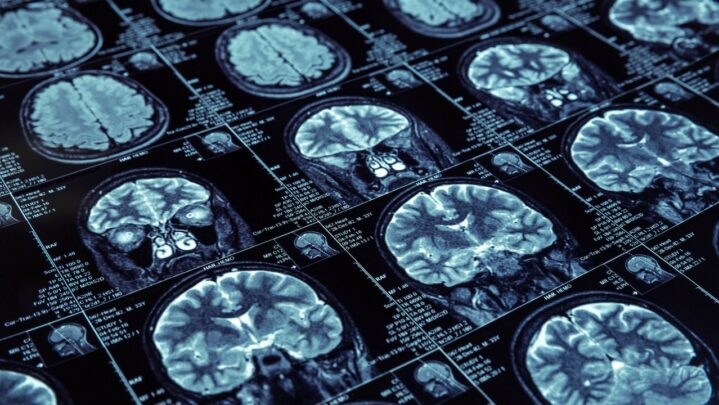 Need For ADHD Brain Scan In Diagnosing And Treating The Patient