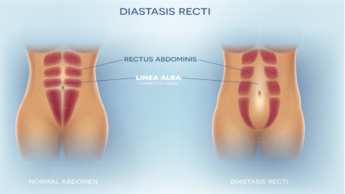 What Is Diastasis Recti: Causes And Treatment