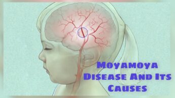 What Is Moyamoya Disease And Its Causes