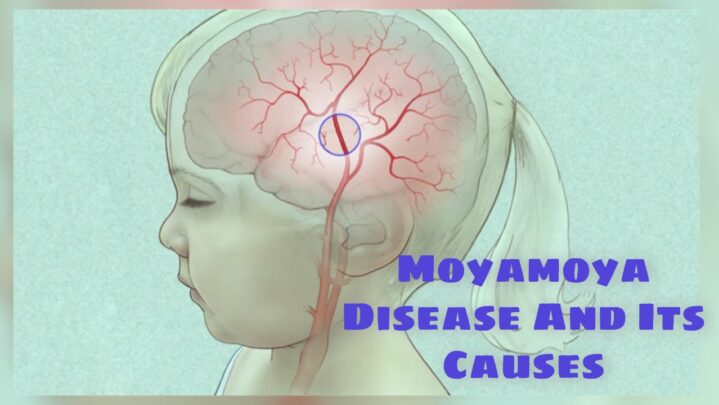What Is Moyamoya Disease And Its Causes