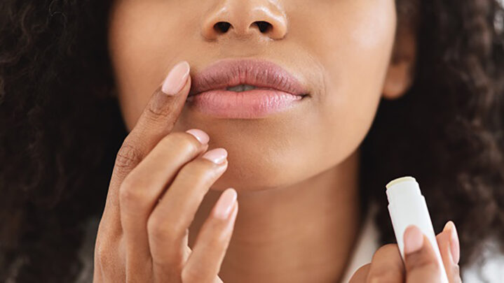 5 Tips To Deal With Sunburned Lips
