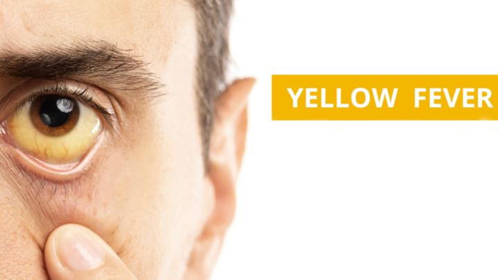Yellow Fever: Causes And Symptoms