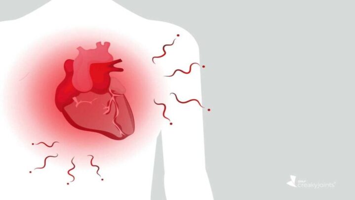 Did You Know: High Uric Acid May Lead To Heart Disease