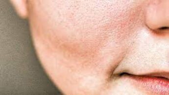 5 Surefire Home Remedies To Get Smaller Pores