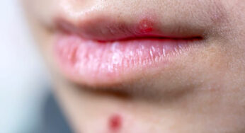 Pimple On Lips: Methods To Deal With It