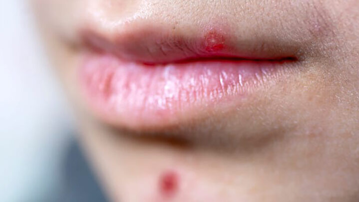 Pimple On Lips: Methods To Deal With It
