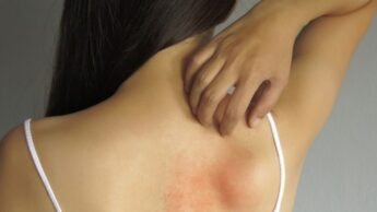 Why Does It Start Itching After Tanning?