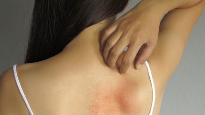 Why Does It Start Itching After Tanning?