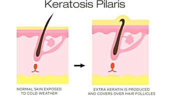 5 Ways To Treat & Prevent Keratosis Pilaris