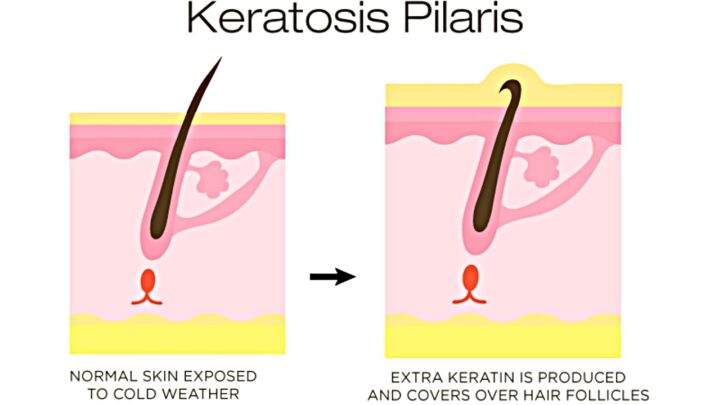 5 Ways To Treat & Prevent Keratosis Pilaris