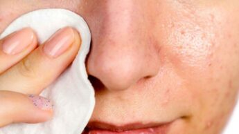 Natural Remedies To Get Rid Of Blackheads – Know Here