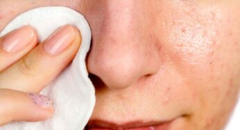 Natural Remedies To Get Rid Of Blackheads – Know Here