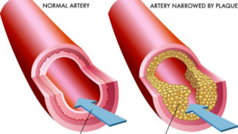 Plaque In Your Arteries? Know What Causes It